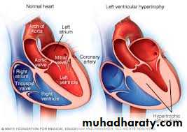 Hypertension