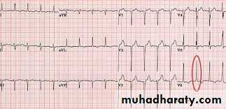 Hypertension