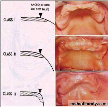 Diagnosis and Treatment Planning for full denture