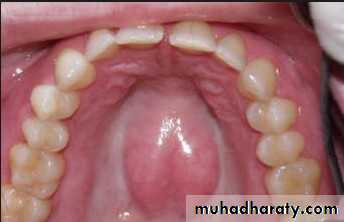 Diagnosis and Treatment Planning for full denture