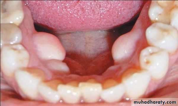 Diagnosis and Treatment Planning for full denture