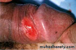 STD