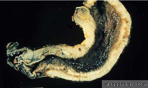 TUMOURS OF THE STOMACH