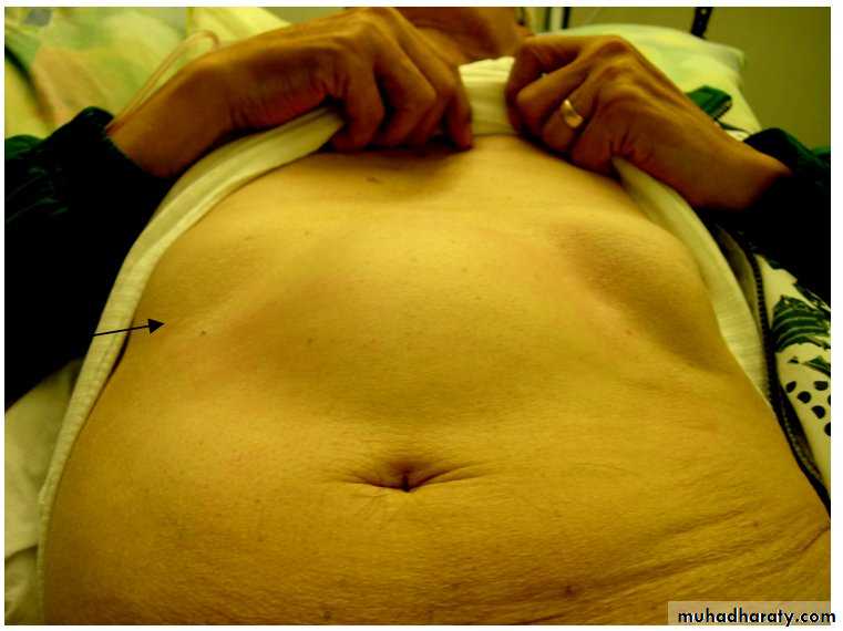 TUMOURS OF THE STOMACH