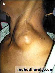 TUMOURS OF THE STOMACH
