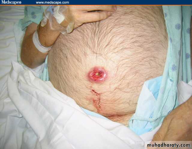 TUMOURS OF THE STOMACH