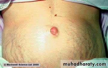 TUMOURS OF THE STOMACH