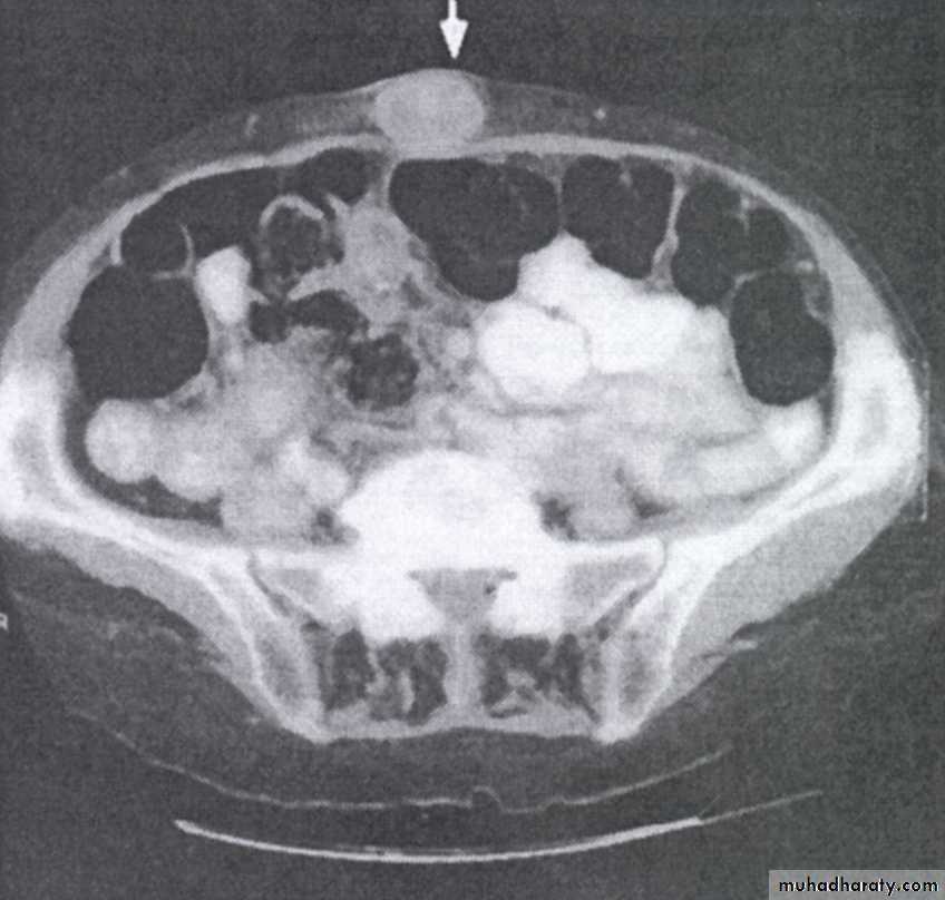 TUMOURS OF THE STOMACH