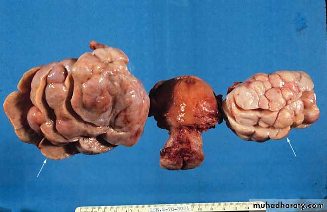 TUMOURS OF THE STOMACH