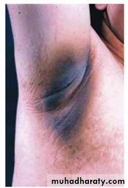 TUMOURS OF THE STOMACH