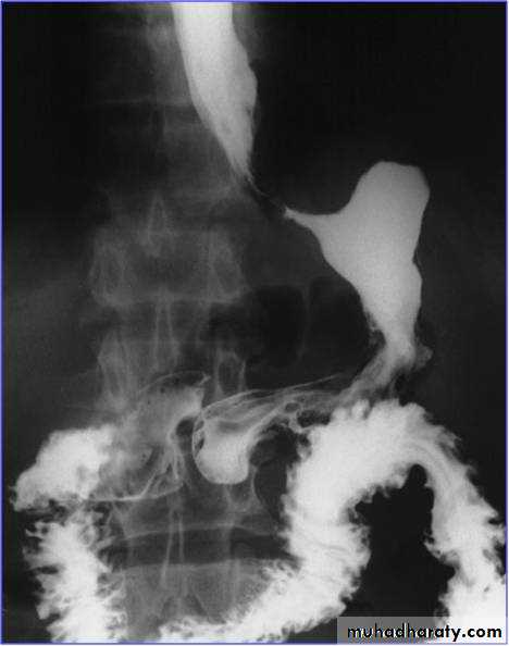 TUMOURS OF THE STOMACH