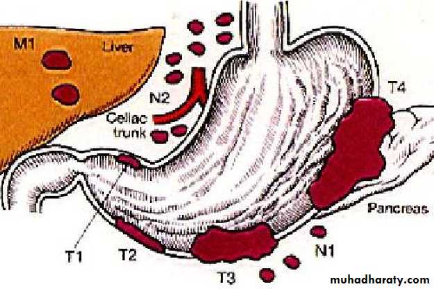 TUMOURS OF THE STOMACH