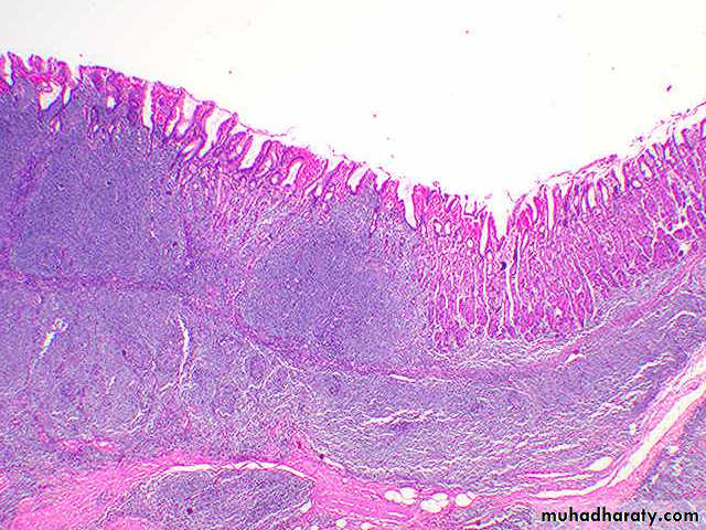TUMOURS OF THE STOMACH