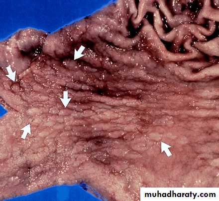 TUMOURS OF THE STOMACH