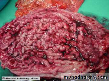 TUMOURS OF THE STOMACH