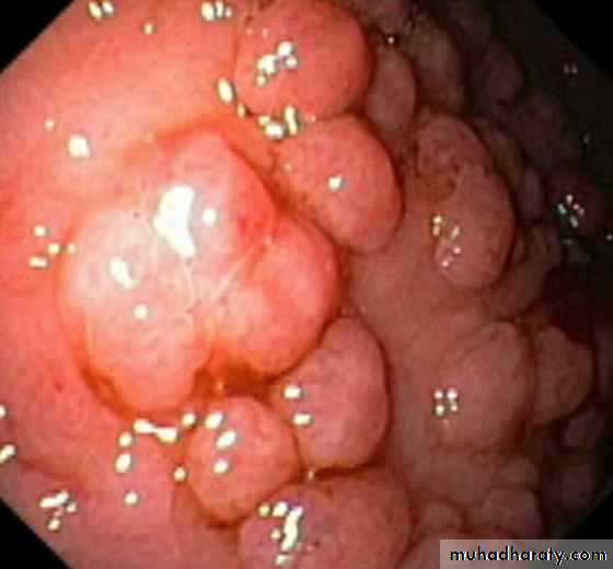 TUMOURS OF THE STOMACH