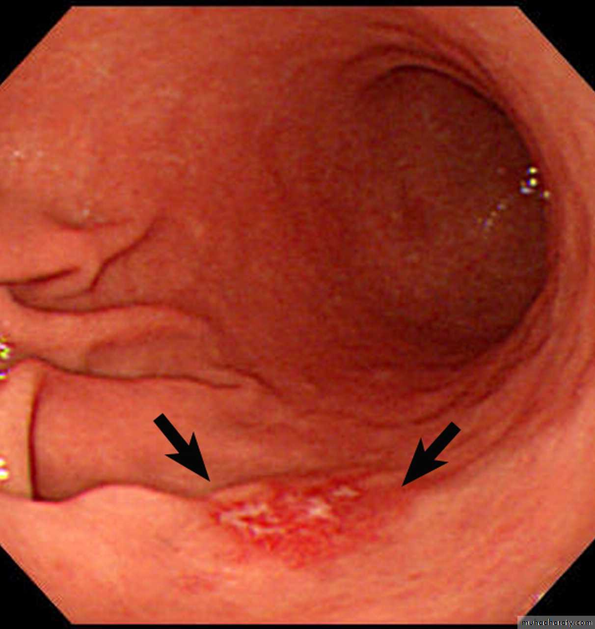 TUMOURS OF THE STOMACH
