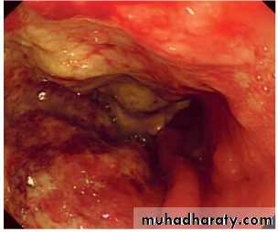 TUMOURS OF THE STOMACH