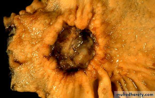 TUMOURS OF THE STOMACH