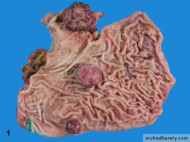TUMOURS OF THE STOMACH