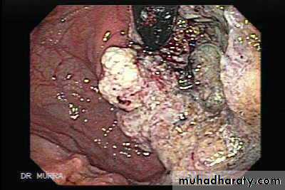 TUMOURS OF THE STOMACH