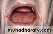 MALABSORPTION