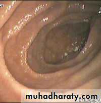 MALABSORPTION