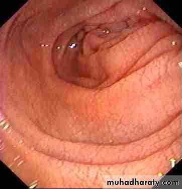MALABSORPTION
