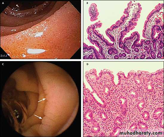 MALABSORPTION