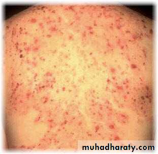 MALABSORPTION