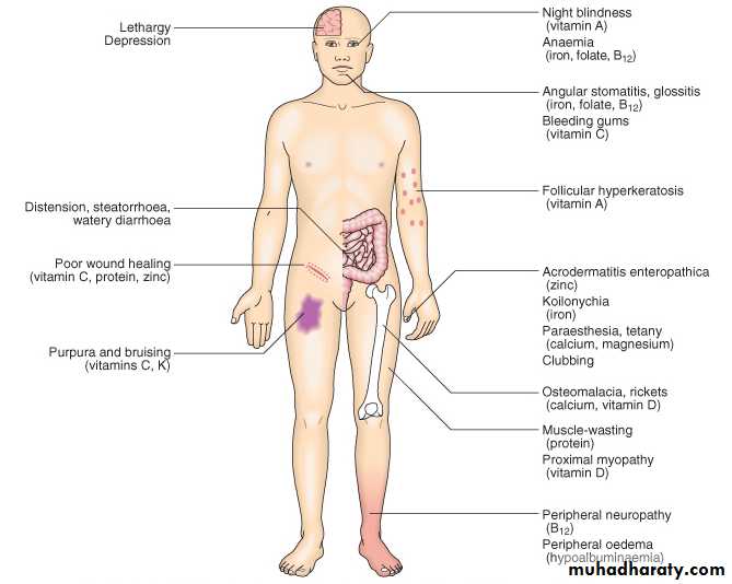 MALABSORPTION