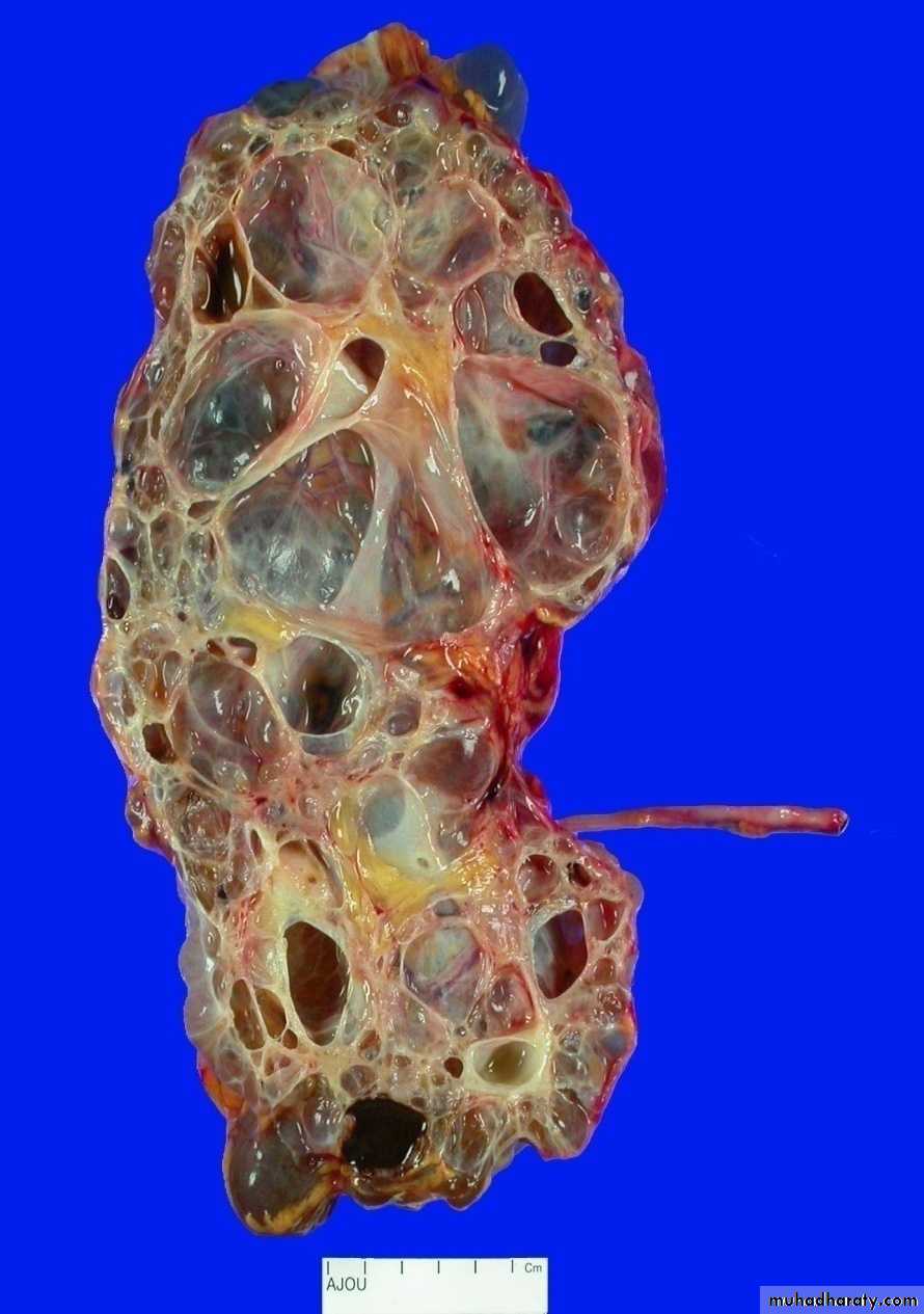 Congenital anomalies of upper ut