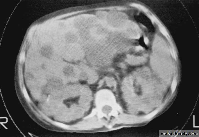Congenital anomalies of upper ut