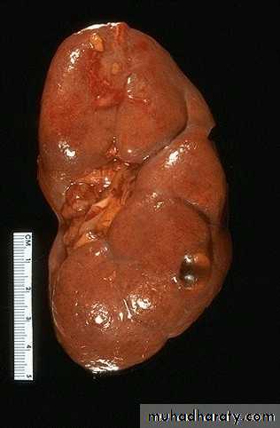 Congenital anomalies of upper ut