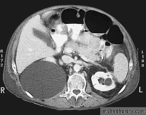 Congenital anomalies of upper ut