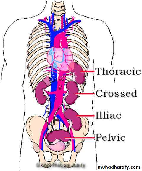 Congenital anomalies of upper ut