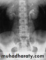 Congenital anomalies of upper ut