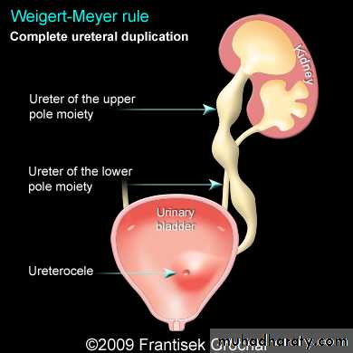 Congenital anomalies of upper ut