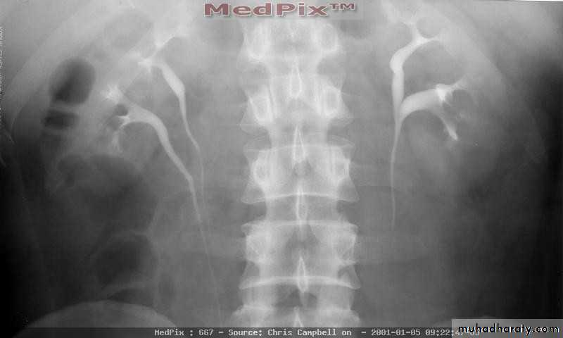 Congenital anomalies of upper ut