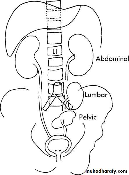 Congenital anomalies of upper ut