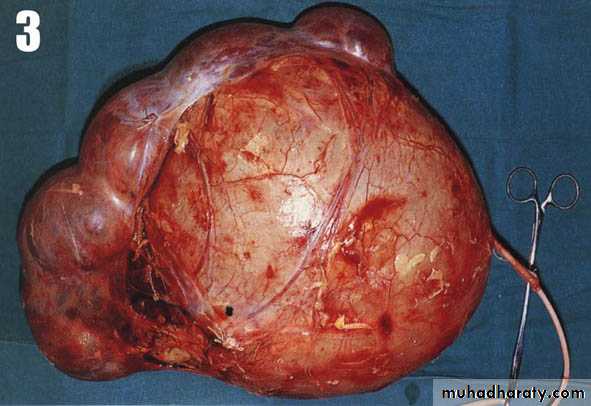 Congenital anomalies of upper ut