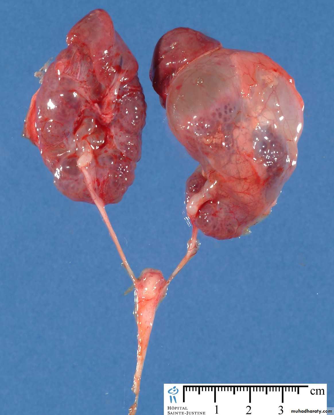 Congenital anomalies of upper ut