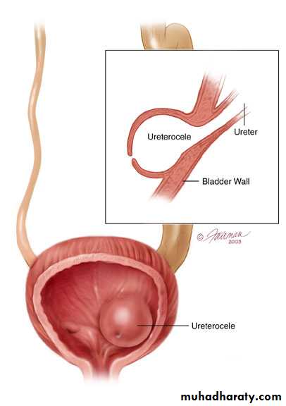 Congenital anomalies of upper ut