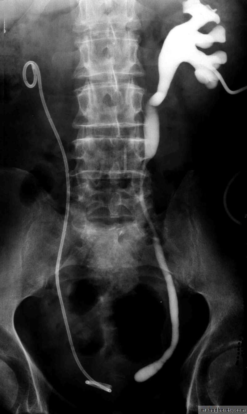 Congenital anomalies of upper ut