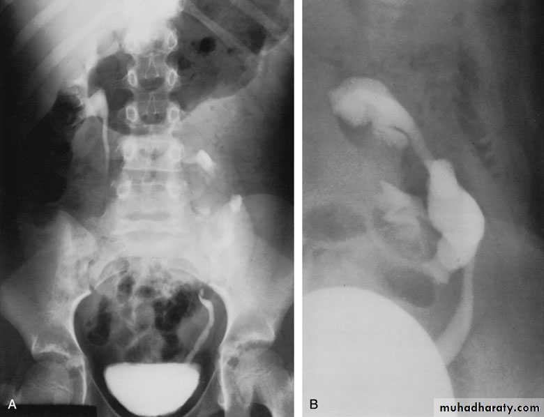 Congenital anomalies of upper ut