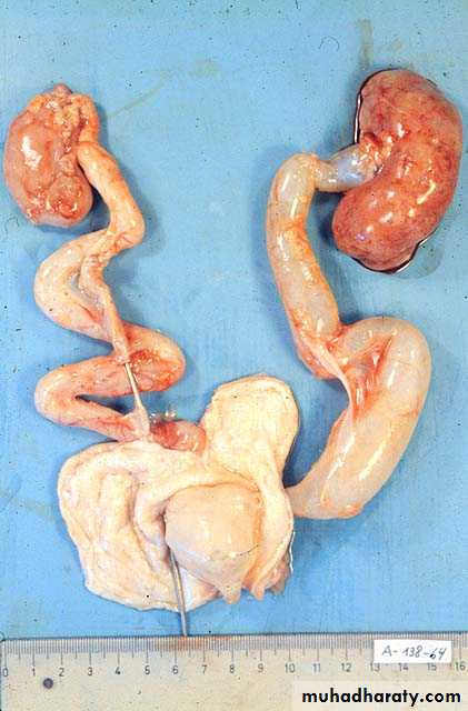 Congenital anomalies of upper ut