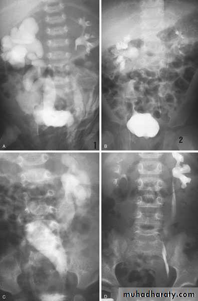 Congenital anomalies of upper ut