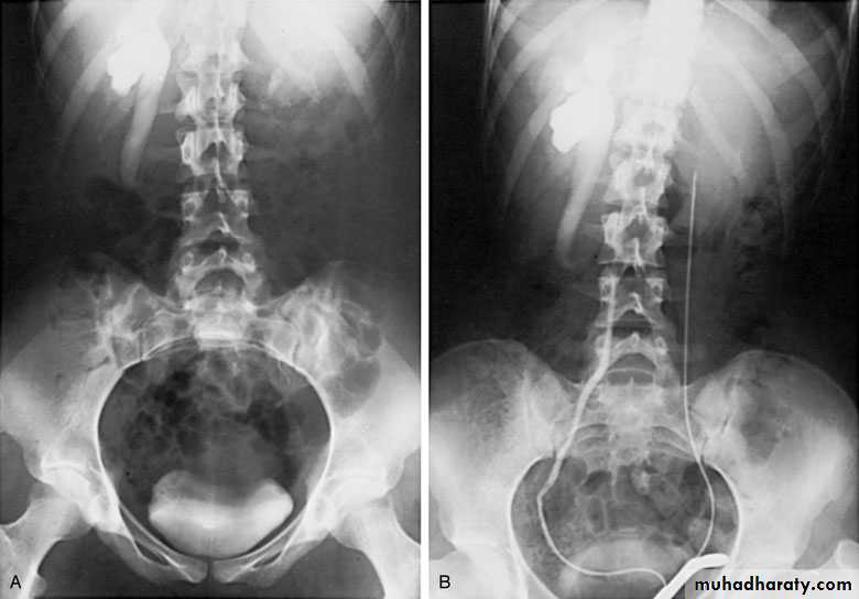 Congenital anomalies of upper ut