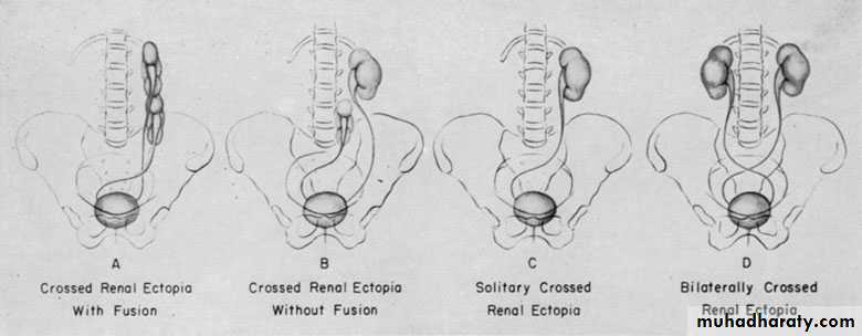 Congenital anomalies of upper ut