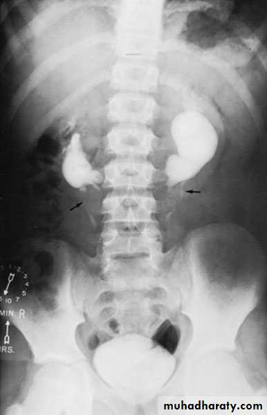 Congenital anomalies of upper ut